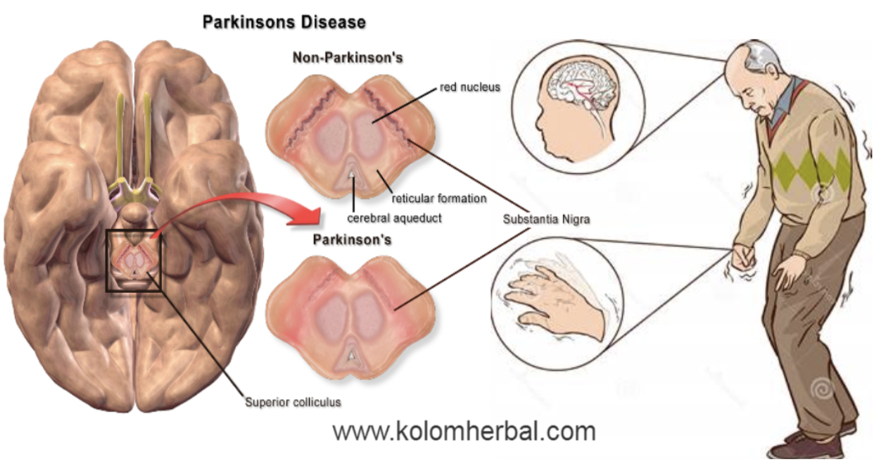Parkinson